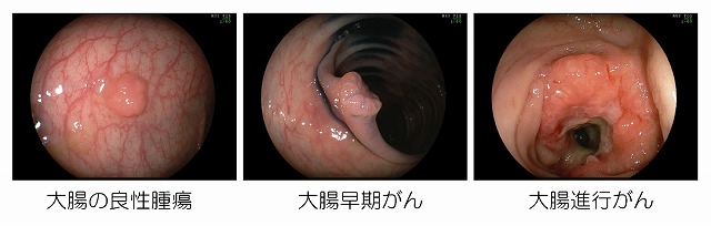 colorectal20tumor.jpg